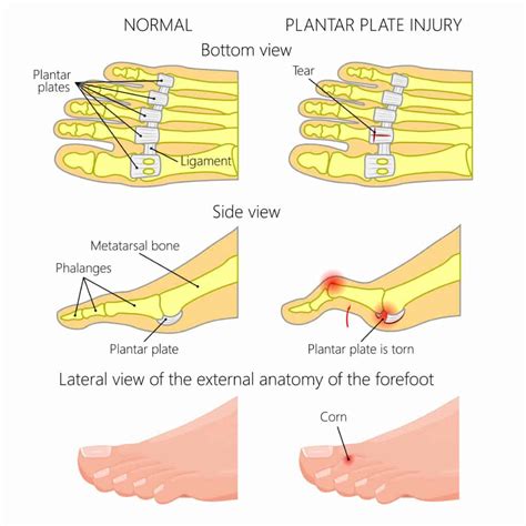 Plantar Plate Tear Symptoms Causes And Treatment