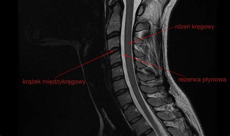 Anatomia i klinika anatomy and clinic. Ucisk rdzenia kręgowego w odcinku szyjnym. Jak go ...