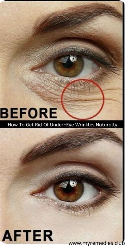 How To Get Rid Of Under Eye Wrinkles Naturally Remove Eye Wrinkles