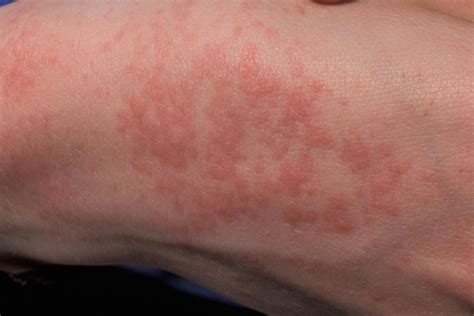 Heat Itchy Rash Pictures Of Skin Rash Get Info On All Types Of Images