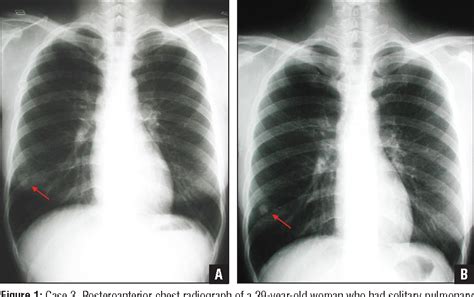 Figure 1 From Giant Cell Tumors Of The Bone With Pulmonary Metastasis