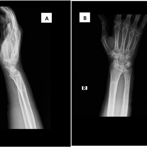 Pdf Case Report Isolated Acute Dorsal Distal Radioulnar Joint Druj Dislocation