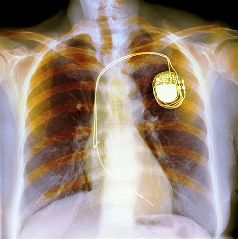 Dual Chamber Pacemaker 3 Photograph By Science Photo Library Fine