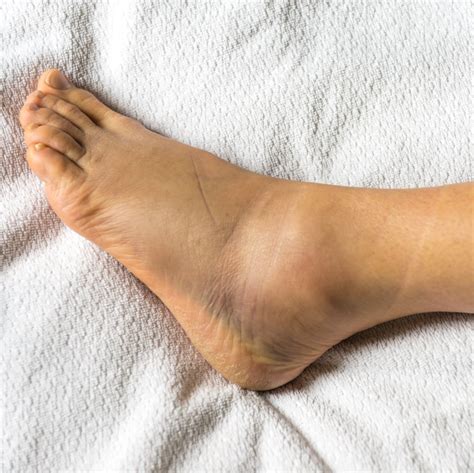 Doctors Explain 12 Reasons You May Be Dealing With Swollen Ankles