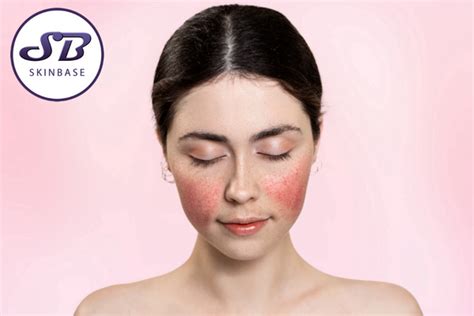 How To Manage Acne Rosacea