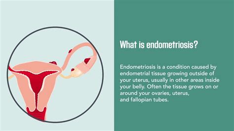 Endometriosis is the abnormal growth of cells (endometrial cells), similar to those that form the inside of the uterus, but in areas outside of the uterus including: Endometriosis: Causes, Symptoms, Diagnosis, and Treatment ...
