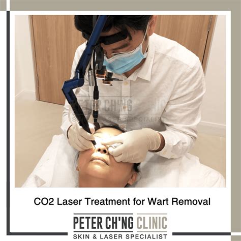 5 Reasons Why You Shouldnt Remove Warts On Your Own Peter Chng Skin