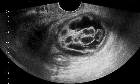 Ovarian Dermoid Cyst Ultrasound