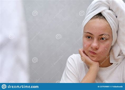 Acne A Teenage Girl Squeezing Out A Pimples On Her Face In Front Of A