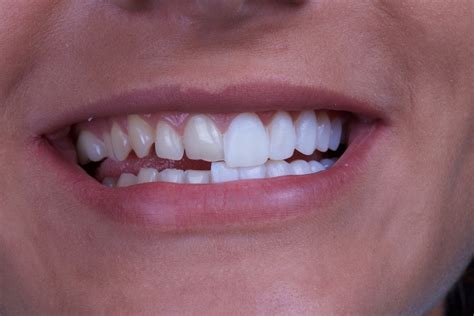 You can choose to veneer some of your teeth. Veneers vs Lumineers by Barotz Dental in Denver, CO