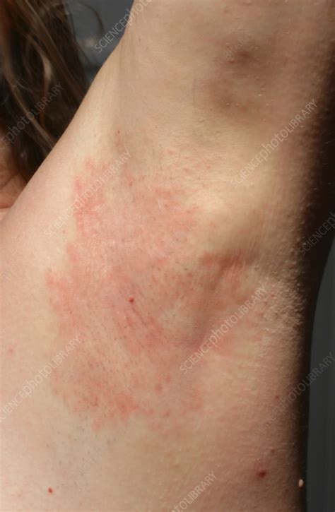 Flexural Psoriasis In The Armpit Stock Image C0559711 Science