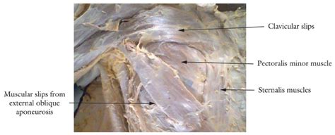 Sternalis Muscle With Deficient Sternocostal Slips Of Pectoralis Major