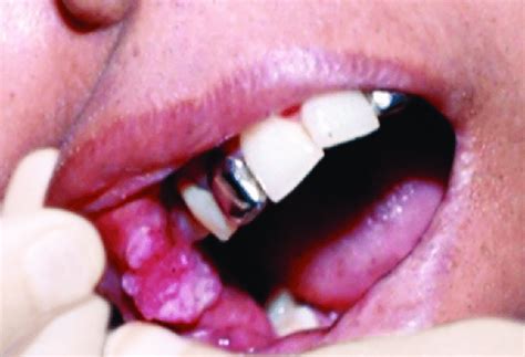 4 Slightly Elevated Leukoplakia Patches On The Right Cheek Download