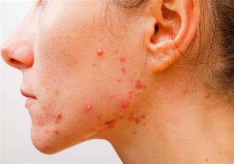 All You Wanted To Know About Pimples And Its Treatment