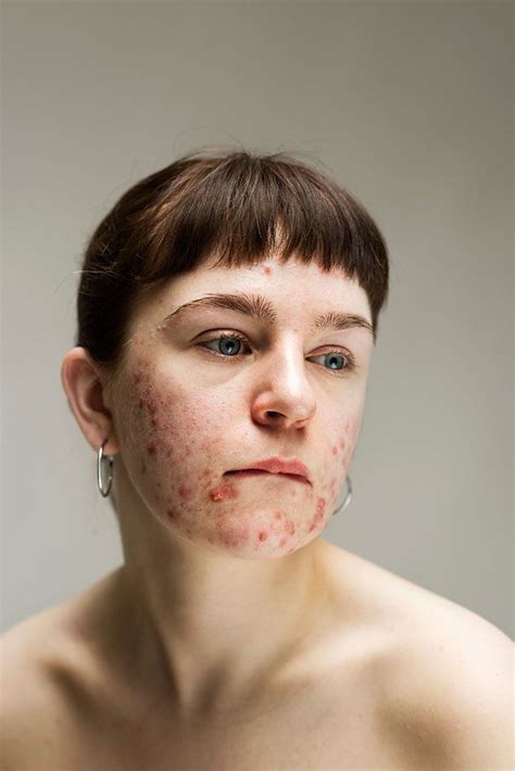 Pin By Anita Life On Acne Positivity ️ Portrait Skin Body Positivity