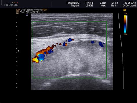 Vietnamese Medic Ultrasound Case 166 Swelling Of Distal Thigh Dr