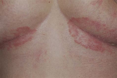 Inverse Psoriasis Of The Inframammary Folds In A 38 Year Old Woman