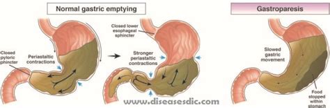 Gastroparesis Definition Causes And Treatment