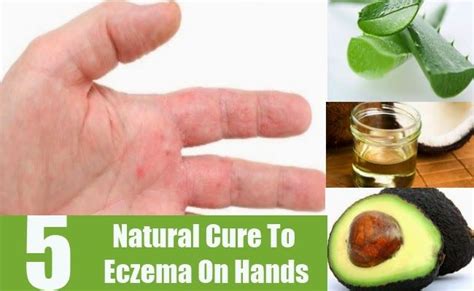 Home Remedies For Eczema On Hands Home Remedies Eczema On Hands