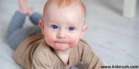 Basic Care For Atopic Dermatitis In Infants
