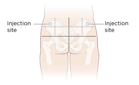 ventrogluteal injection site method things you should know