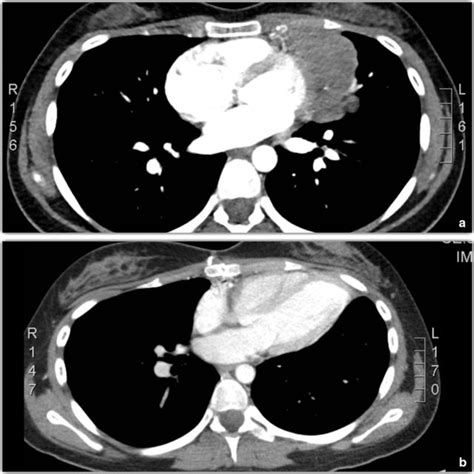 Chest Computed Tomography Ct Scan At Baseline And After Surgery A