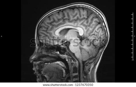 Magnetic Resonance Image Mri Brain Sagittal Stock Photo Edit Now
