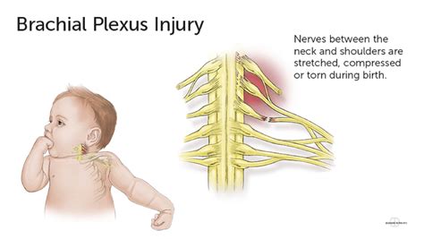 Shoulder Dystocia Brachial Plexus Injuries G Eric Nielson Associates