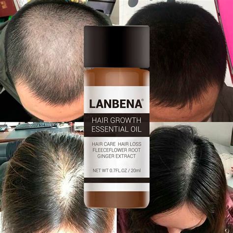 Hair oil formula d hair regrowth serum for fast hair growth dht blocker for men and women with jamaican black castor oil, edenkingdomessential. Aliexpress.com : Buy LANBENA Hair Growth Essential Oils ...