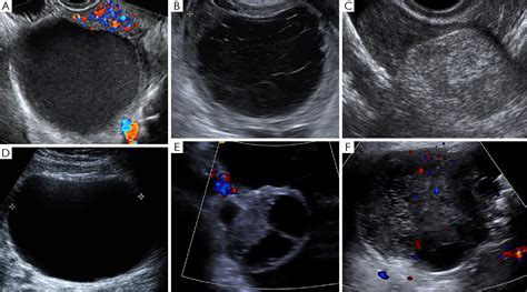 Figure 1 From Imaging And Diagnostic Approach Of The Adnexal Mass What