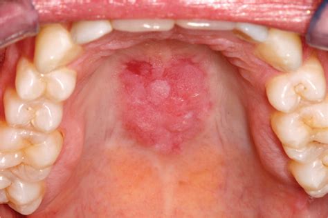 Oral Manifestations Of Systemic Disease Aafp