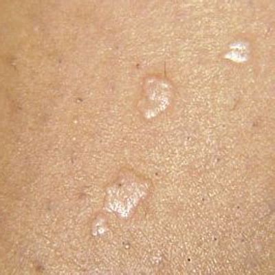 How To Distinguish Flat Warts From Other Similar Looking Skin