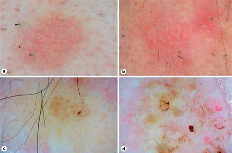 Dermoscopy Of Actinic Keratosis Intraepidermal Carcinoma And Squamous