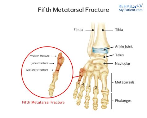 5th Metatarsal Fracture Motus Physical Therapy