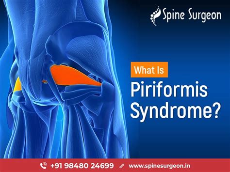 Everything You Need To Know About Piriformis Syndrome Spine Surgeon