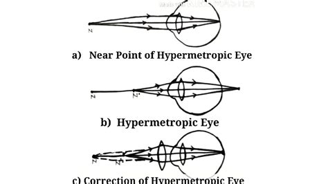Hypermetropia Eye Correction Diagram Hypermetropic Eye Correction