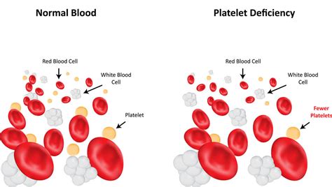 Low Blood Platelets Thrombocytopenia In Cats Cat World