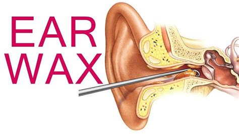 Ear Wax Removal Safe Ear Wax Removal For Improved Ear Health
