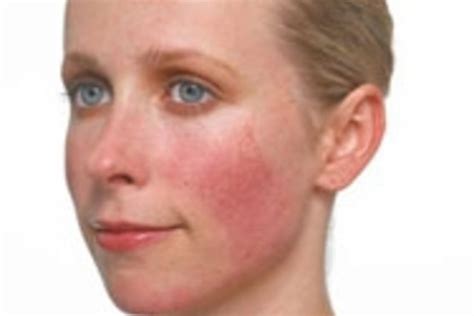 Beauty Tip Of The Day Ruddy Cheeks Natural Rosacea Treatment