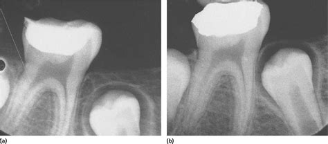 17 Pulp Therapy Of Immature Permanent Teeth Pocket Dentistry