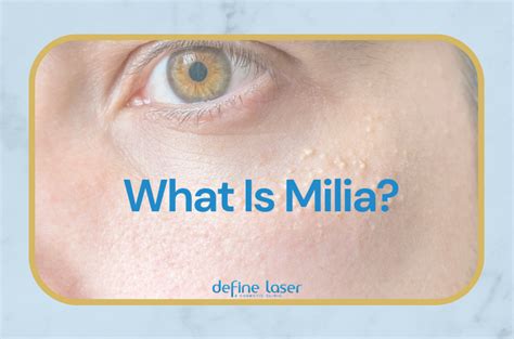 What Is Milia And Can It Be Treated