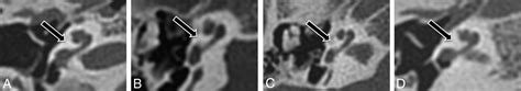 The Unwound Cochlea A Specific Imaging Marker Of Branchio Oto Renal