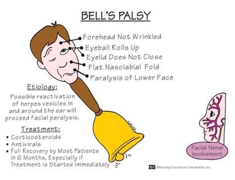 Bell S Palsy Nursing Mnemonics Nurse Medical Surgical Nursing
