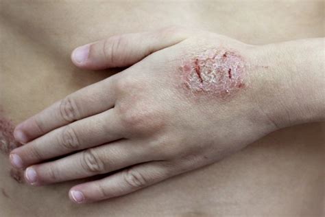 Dermatite o que é sintomas tipos causas e tratamento com fotos DF EXPRESSO
