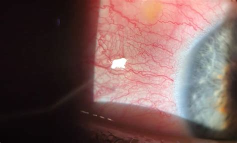 Optometry Case Study Nodular Episcleritis Spectrum