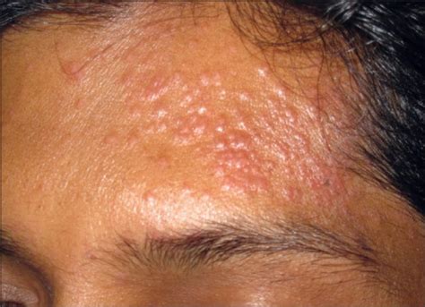 Papular Lesions Over Forehead Open I
