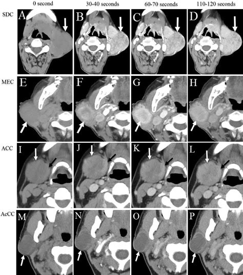 Multiphase Contrast Enhanced Computed Tomography Imaging Features Of