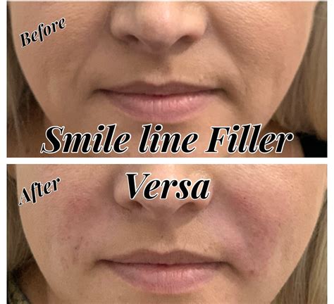 Best Treatments For Nasolabial Folds And Marionette Lines