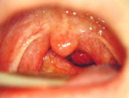Predisposing factors preventing nasal polyps. Antrochoanal Polyps Symptom | Chronic Sinusitis ...
