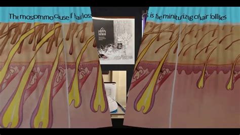 Hair regrowth treatment for women. Hair Growth Clinic Presentation - YouTube